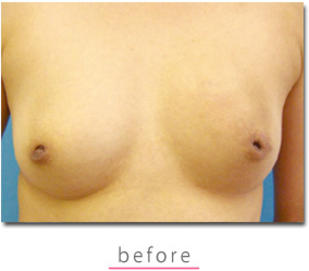 【陥没乳頭】の症例写真 before【1枚目】