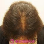 【オリジナル発毛薬・メソセラピー|tbc_um】髪密度に変化が現れていますの症例