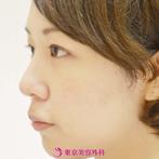 【オーダープロテーゼ&鼻尖形成（自家軟骨）ｌｇｚ1538】整った鼻でバランスの良い顔にの症例