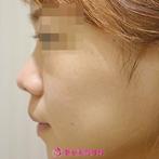 【オーダープロテーゼ&小鼻縮小（内・外）&鼻中隔延長（東美オリジナル）|ｇｚ186】すっきりとした鼻にの症例
