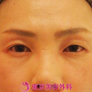 【埋没|ｆｙ1895】の症例写真 before【1枚目】