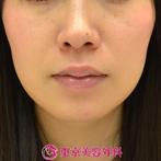 【顎ヒアルロン酸＆ボトックス|gz】ヒアルロン酸で簡単に横顔美人の症例