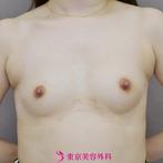 【胸の脂肪注入|ｇｚ2091】胸の脂肪注入で自然な形にバストアップの症例