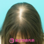 【オリジナル発毛薬｜ar2235】地肌の透けが改善の症例