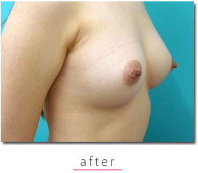【エンジェルバッグ：ハリのあるバストにしたかったので施術を受けました】の症例写真 after【6枚目】