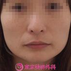 【エラ ボツリヌストキシン|ar2387】小顔注射をするだけで手軽に小顔をGET♪の症例