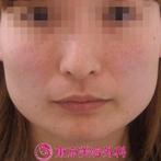 【エラ ボツリヌストキシン|ar2387】小顔注射をするだけで手軽に小顔をGET♪の症例