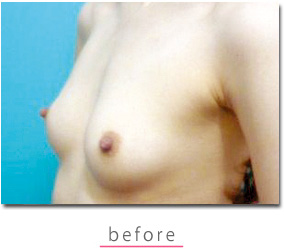 【エンジェルバッグ】の症例写真 before【7枚目】