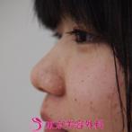 【小鼻縮小】鼻が変わるだけで顔全体の雰囲気が変わるの症例