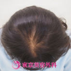 【オリジナル発毛薬・メソセラピー｜ar3064】50代女性。頭頂部の透けが分かりやすく改善されています！の症例