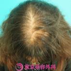 【オリジナル発毛薬・メソセラピー|ok】染めたりパーマをあてたりで痛んだ髪も徐々に復活！の症例