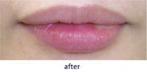 【ヒアルロン酸注入】加齢による唇のシワにも効果を発揮します。の症例