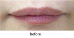 【ヒアルロン酸注入】加齢による唇のシワにも効果を発揮します。の症例