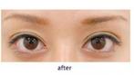 【クイック法片目修正】片目のみ修正して左右ともに同じ大きさの瞳の症例
