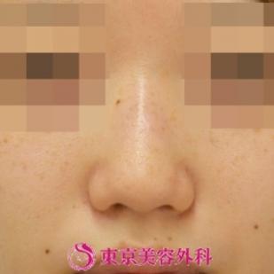 【鼻プロテーゼ＆鼻尖形成|gz】の症例写真 before【5枚目】