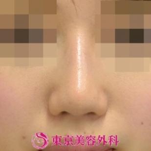 【鼻プロテーゼ＆鼻尖形成|gz】の症例写真 after【6枚目】