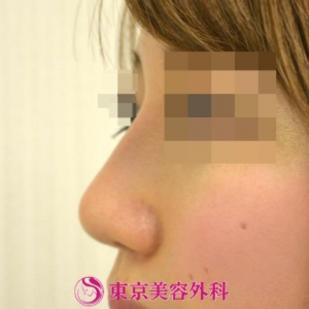 【鼻プロテーゼ＆鼻尖形成|gz】の症例写真 after【2枚目】