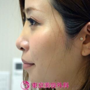 【培養軟骨の隆鼻＆小鼻縮小|gz212】の症例写真 before【1枚目】