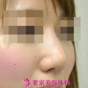 【鼻プロテーゼ＆鼻尖形成|gz】の症例写真 after【4枚目】