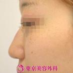 【鼻プロテーゼ＆鼻尖形成|gz】の症例
