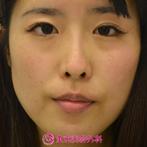 【エラボツリヌストキシン|gz】エラがなくなりシャープな顔にの症例