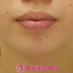 【あごプロテーゼ|gz】鼻先から顎先まで一直線になりバランスの良い顔にの症例