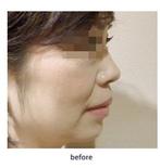 鼻中隔延長術で美しい鼻を形成しますの症例