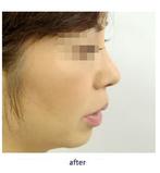 鼻中隔延長術で美しい鼻を形成しますの症例
