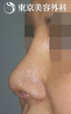 【他院修正｜JJ021】感染による拘縮（ひきつれ）した鼻の症例
