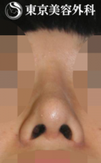 【小鼻縮小｜JJ006】丸みのある小鼻の症例