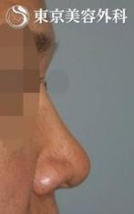 【他院修正｜JJ020】感染により拘縮（引きつれ）をきたし、上を向いた鼻の症例