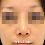 【鼻尖形成｜gz2186】鼻先を整えてシャープな鼻にの症例