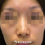 【鼻尖形成｜gz2186】鼻先を整えてシャープな鼻にの症例