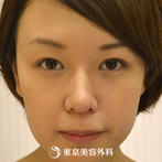 【鼻プロテーゼ&鼻尖形成｜gz1538】鼻先を整えてモデルのようなシャープな鼻にの症例