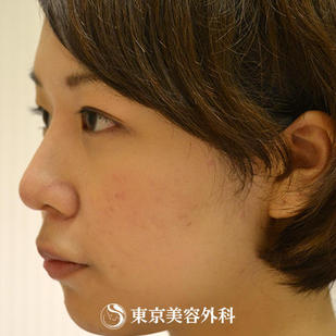 【鼻プロテーゼ&鼻尖形成｜gz1538】の症例写真 after【4枚目】