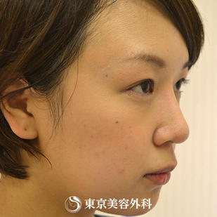 【鼻プロテーゼ&鼻尖形成｜gz1538】の症例写真 after【6枚目】