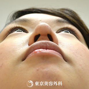 【鼻プロテーゼ&鼻尖形成｜gz1538】の症例写真 after【10枚目】