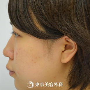 【鼻プロテーゼ&鼻尖形成｜gz1538】の症例写真 before【7枚目】