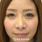 【小鼻縮小&隆鼻術&鼻中隔延長&鼻尖形成｜gz212】鼻筋を整えて美しい顔立ちへの症例