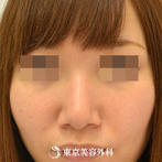 【鼻尖形成&小鼻縮小｜gz2851】広がった鼻を整え、女性らしい顔立ちへの症例