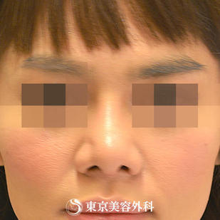 【鼻尖形成&鼻プロテーゼ&鼻翼縮小｜gz337】の症例写真 after【2枚目】