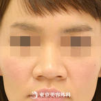 【鼻尖形成&鼻プロテーゼ&鼻翼縮小｜gz337】すっきりとした鼻にの症例
