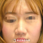 【小鼻縮小（外側切開+ケーブル法）｜gz3450】広がった鼻を整え女性らしい顔立ちへの症例