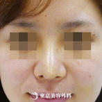 【鼻尖形成&鼻プロテーゼ｜gz3531】スッとのびたきれいな鼻先にの症例