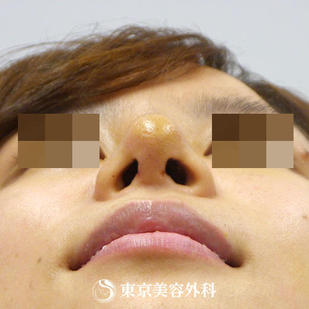 【鼻尖形成&鼻プロテーゼ｜gz3531】の症例写真 after【8枚目】