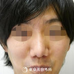 【鼻尖形成｜gz482】鼻先を整えてすっきりとしたラインにの症例