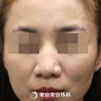 【鼻尖形成&鼻プロテーゼ&鼻孔縁形成｜si172】鼻の形に合わせたプロテーゼで理想の鼻筋にの症例
