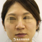 【鼻ヒアルロン酸｜si211】メスを使用せず数分で思い通りの鼻筋にの症例