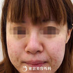 【隆鼻術｜ar2341】鼻を高くしスッと通った鼻筋にの症例