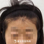 【オリジナル発毛薬・メソセラピー｜ar3064】女性発毛 年齢：54歳の症例